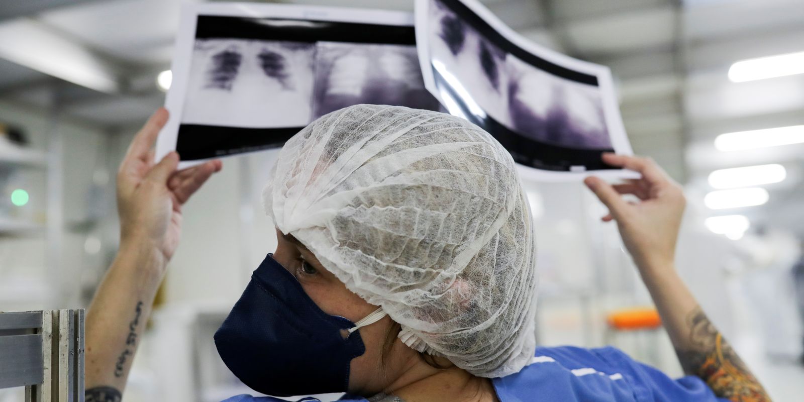 Câncer de pulmão: diagnóstico tardio reduz chances de cura no Brasil