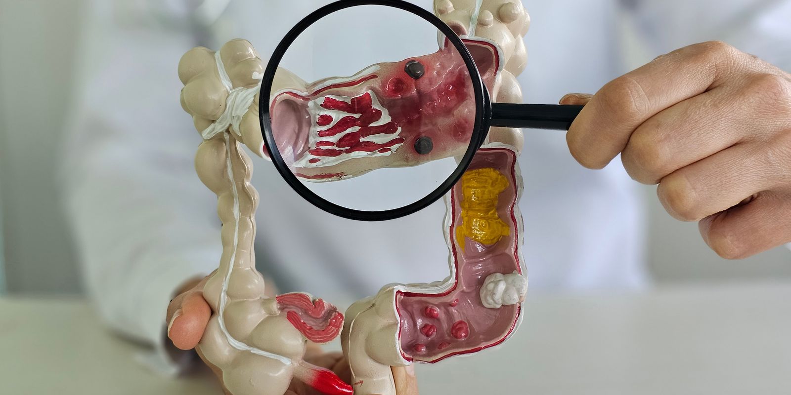Crescimento alarmante das doenças inflamatórias intestinais no Brasil em 13 anos